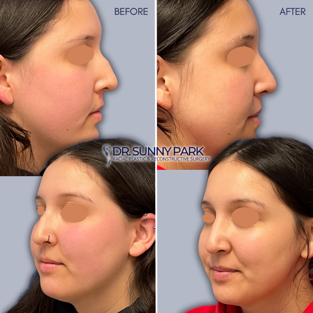 Before-and-After Facelift Results - Dr. Sunny Park | Top Plastic